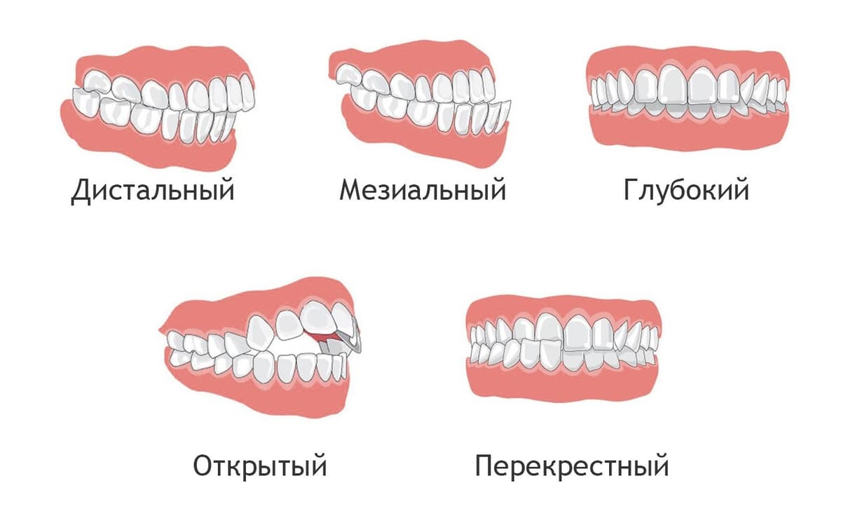 Виды прикусов