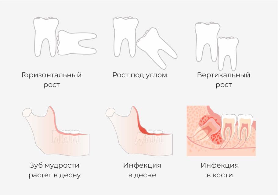 Рост зуба